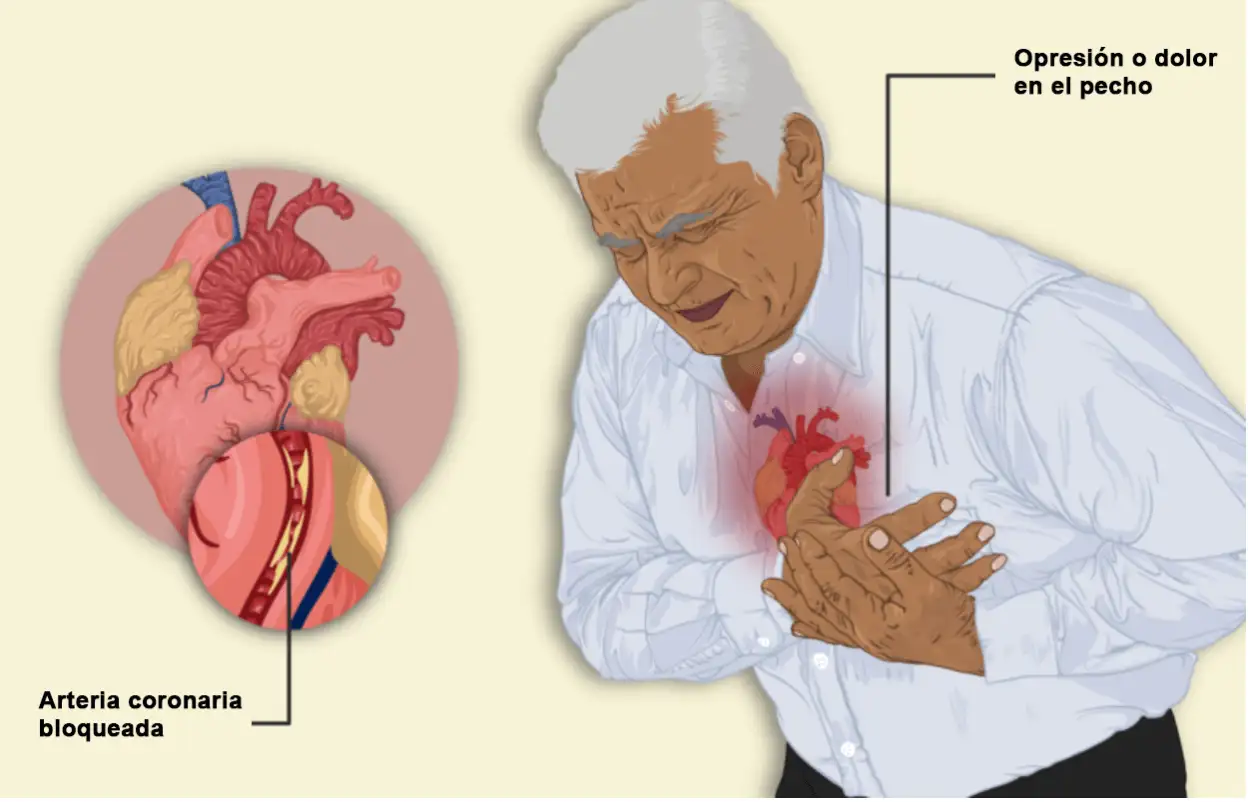 Un hombre que tiene un ataque al corazón